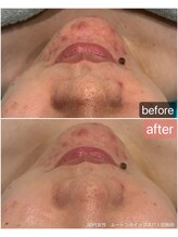 サロン テン(salon TEN)/肌荒れやニキビに