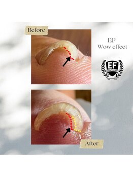 ファースト(FIRST)/巻き爪ケア