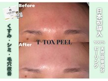 リシェリ 代官山(RICHERI)/日本初導入！T-TOX PEEL