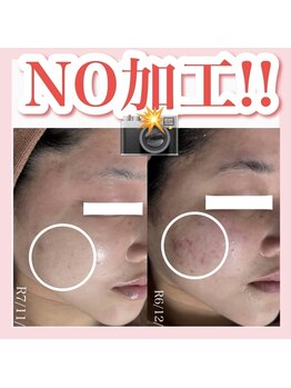 アルムダアクア 天王寺店(Aleumda AQUA)/ハーブピーリング/大阪/天王寺