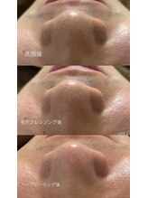 ビーグロウ(be Grow)/毛穴洗浄+ハーブピーリング