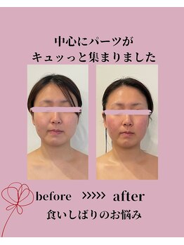 風薫(フウカ)/小顔│ビフォーアフター