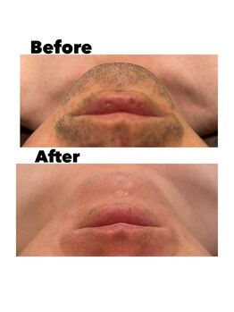 ピノ 西尾店(PINO)/【メンズ脱毛】顔脱毛/髭脱毛