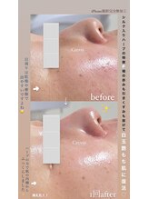 クレヴィー(Creviy)/3D毛穴洗浄×ハーブピーリング