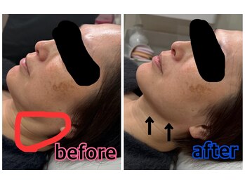 ナッツ(Nuts)/幹細胞/エクソソーム