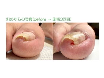 ファースト(FIRST)/巻き爪ケア