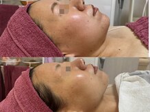 GRACETHOUSAND(グレイスサウザンド)/ハーブピーリング/毛穴洗浄