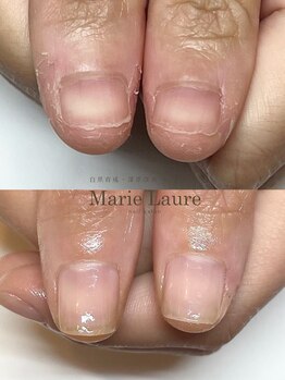 マリーロール 梅田店(Marie Laure)/自爪育成/深爪矯正/ネイルケア