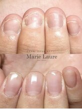 マリーロール 天王寺店(Marie Laure)/自爪育成/深爪矯正/ネイルケア