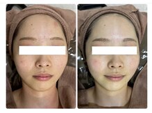 ホワイトアクア 北千住店(WHITE AQUA)/ハーブピーリング/肌質改善/毛穴