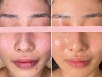 エイプリルフールズ(April fools)/【20代】褒められる肌へ変化！