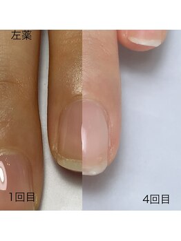 自爪育成・深爪育成