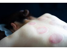 キズナ(Kizuna)/カッピングを外すと！