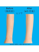 ブロッサム(BLOSSOM)/ヒジ下脱毛