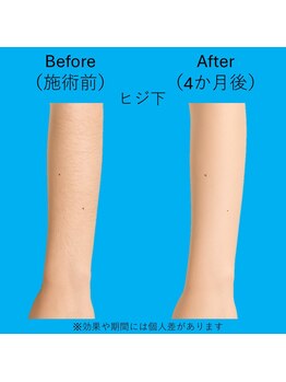 ブロッサム(BLOSSOM)/ヒジ下脱毛