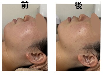 カリアンヌ/推し活前の小顔フェイシャル