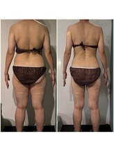 OBS/脂肪冷却プログラム×体重減少