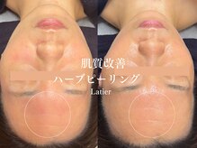 ラティエ(Latier)/肌トラブル繰り返さないお肌へ