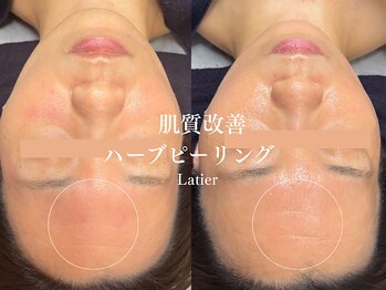 ラティエ(Latier)/肌トラブル繰り返さないお肌へ