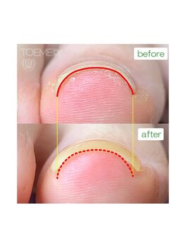 ファースト(FIRST)/巻き爪ケア