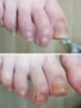 リゼラアンドコー 名古屋栄店【フットケア/巻き爪/足裏角質/爪トラブル】/