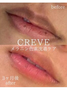 クレーヴ(CREVE)/くちびるメラニンケア