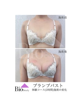 バイオビューティー 神戸本店(Bio Beauty)/プランプバスト　施術症例