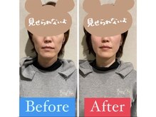 ナオル整体 宮崎院(NAORU整体)/40代女性施術例【リフトアップ】