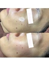 ラエッセ(LAESSE)/ゴワつき肌もキレイに♪