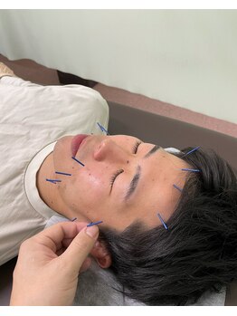 ヒューマン鍼灸接骨院/男性も♪メンズ美容鍼♪