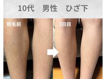 バーム(BAAM)/施術経過