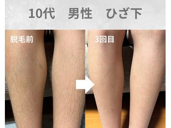 バーム(BAAM)/施術経過