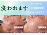 【ニキビ改善】繰り返さない美肌へ・肌が変わると世界が変わる￥15,600→
