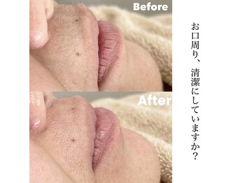ここはな/お口周りの気になる産毛を綺麗に
