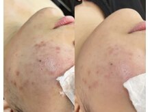 アンジェ(ange)/美肌ラボange式肌管理の鎮静力