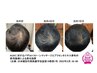 【育毛促進】学術論文掲載☆バザルト育毛促進寝落ちヘッド50分☆水素足湯付