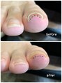 エヌドットバーバーヒロオ ネイル(N.BARBER HIROO) 今ある痛みの緩和、お爪のお悩みは何でもご相談下さい!