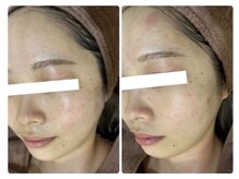 ホワイトアクア 北千住店(WHITE AQUA)/ハーブピーリング/肌質改善/毛穴