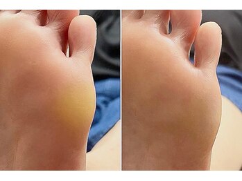 イーデザイン ネイル(E.design.Nail)の写真/どんな時でも自信の持てる素足に♪足の裏のザラつきやかかとのガザガザは当店のフットケアにお任せ◎