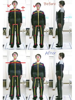姫路なごみ整体院 なごみ鍼灸院/(改善例)　左慢性的なお尻の痛み