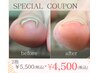 【初回限定★巻爪解放】プレートを使った巻き爪ケア（両足）¥5500→¥4500