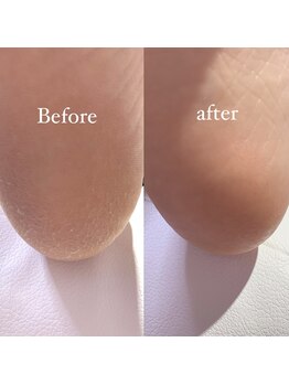 メリーミー(Merry me)/フット角質ケア　