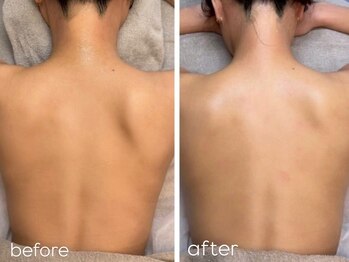 エルピス(ELPIS)/背中Wax脱毛