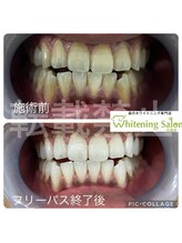 ホワイトニングサロン 広島店/【ホワイトニング施術例】