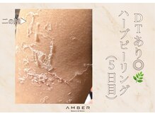 アンバー 恵比寿(AMBER)/DT有ハーブピーリング