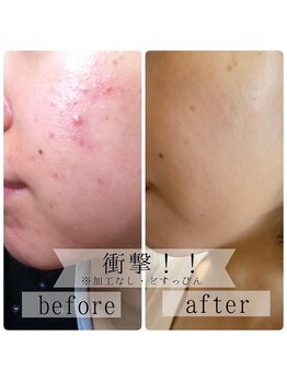 ソワン(Sowan)/漢方ハーブピーリング