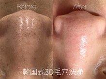 ビヨンド リンク(BEYOND L'INK)/韓国式3D毛穴洗浄