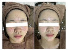 ホワイトアクア 北千住店(WHITE AQUA)/ハーブピーリング/肌質改善/毛穴