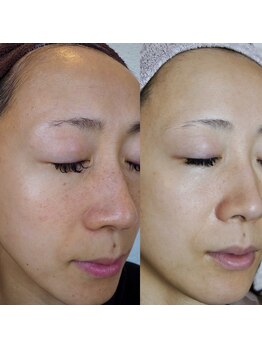 ザ シー タイムレスビューティ(THE SHE)/30代お客様症例写真