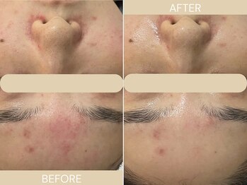 エクラ(eclat)/施術回数:1回